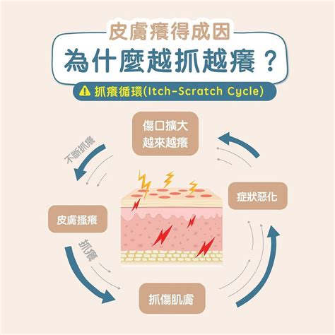 為什麼皮膚越抓越癢|莫名皮膚癢怎麼辦？10種可能原因公開：濕疹、糖尿病。